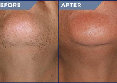 Before and After Laser Treatment Services, Beauty Land Services, BC