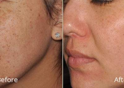 Facial Issues, Before and After Services, Beauty Land Services, BC