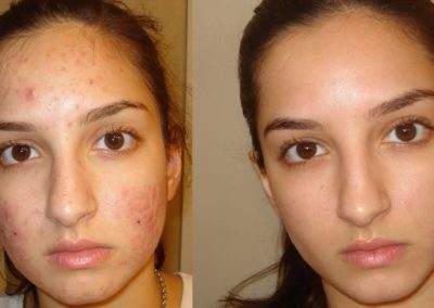 Before and After Acne Treatment Services, Beauty Land Services, BC
