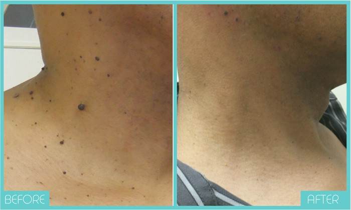 Gallery - Mole and Warts Removal - Beauty Land