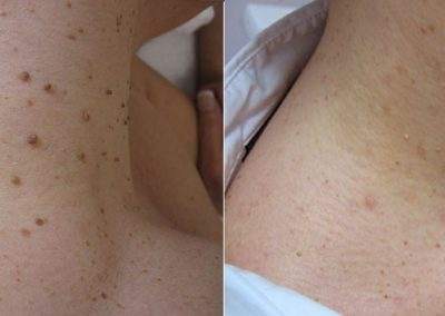 Before and After Skin Services, Mole Removal, Beauty Land, BC